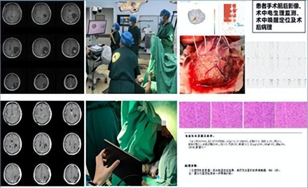 颅脑手术中唤醒患者背古诗！云南省首例